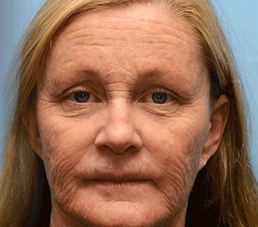 The (VIRAL) Bee Venom Wrinkle Cream