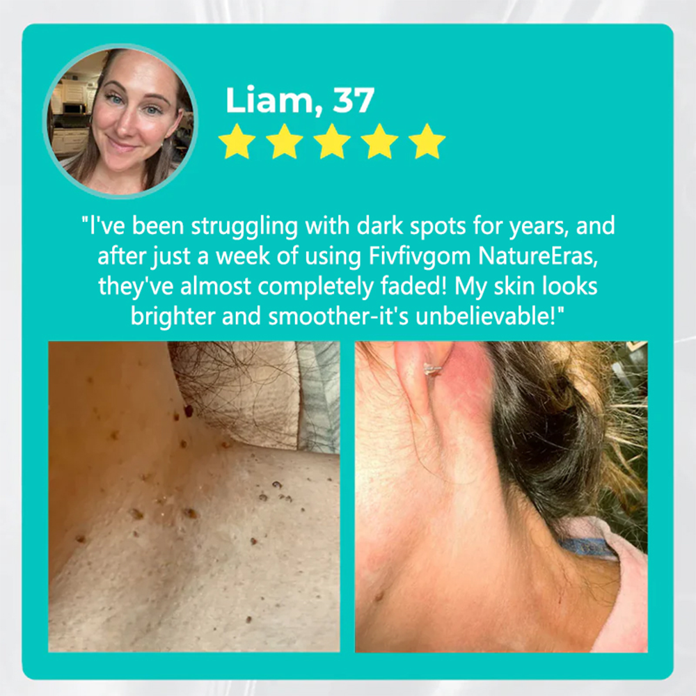 ✅ Official Store: LOVILDS™ NatureErase Instant Alligator Oil Mole & Spot Removal Gel