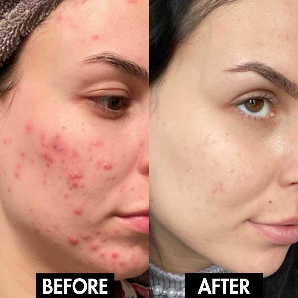 Lunaris™ Facial Purity Device