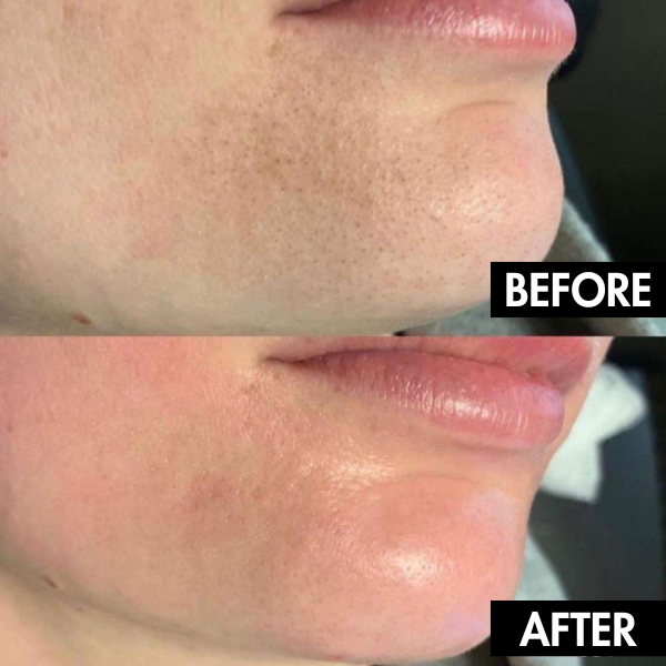 Lunaris™ Facial Purity Device